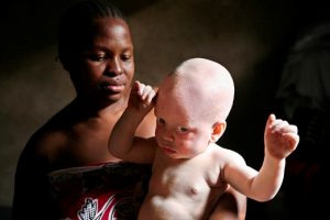 Tanzania’s albinos stalked by cancer, stigmatization and murder